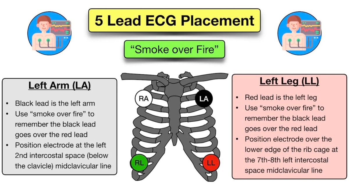 leads for EKG